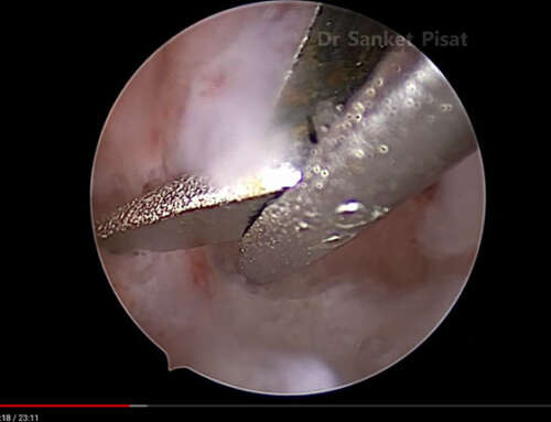Hysteroscopic Synechiolysis- (Asherman’s Syndrome)