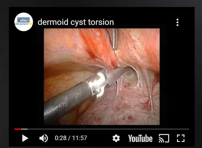 Dermoid cyst torsion 2 – ISGE