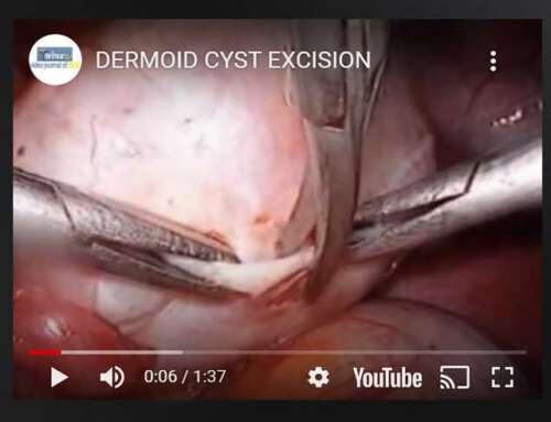 Excision of dermoid cyst