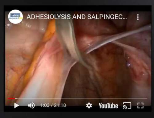 Adhesiolysis and salpingectomy for endometriosis