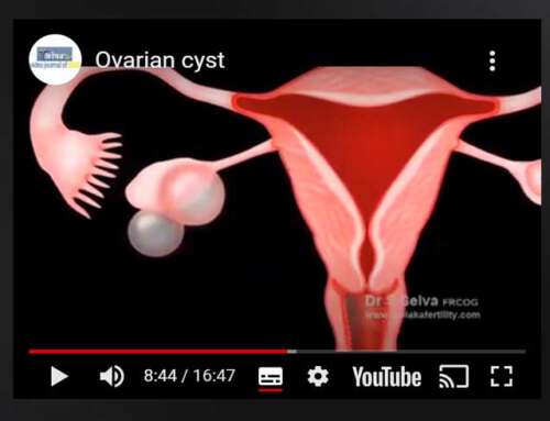 Ovarian cyst