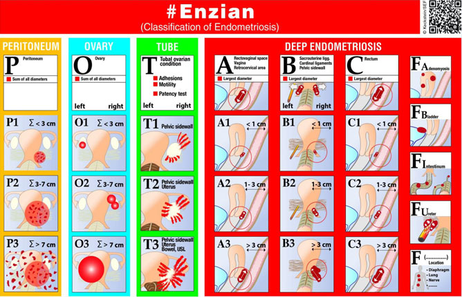 Kidney Endometriosis - Seckin Endometriosis Center