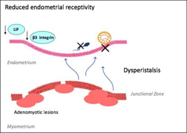 Improved reproductive outcomes in women with adenomyosis