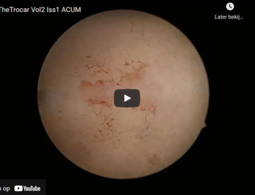 Laparoscopic management of a case of accessory cavitated uterine mass (ACUM)