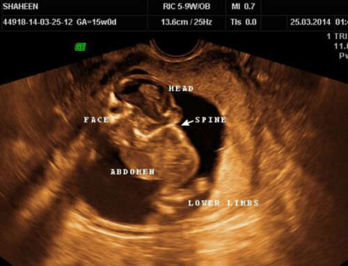 Antenatal ultrasound diagnosis of ‘Iniencephaly Apertus’