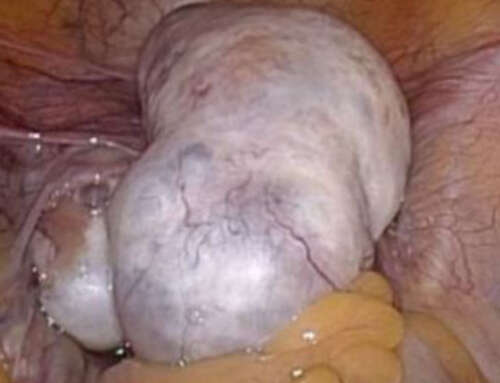 Bilateral and Multiple Mature Teratomas of the Ovary; A Case Report and Brief Review of Literature