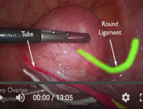 Accessory cavitated uterine mass (ACUM). Laparoscopic diagnosis and management of a rare class U6 uterine malformation