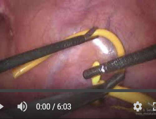 Using Foley’s catheter as a tourniquet during laparoscopic myomectomy