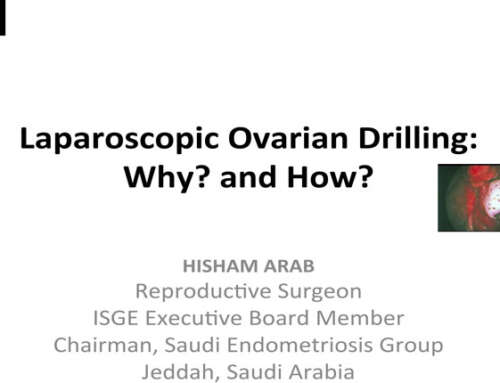 Ovarian drilling for the treatment of policystic ovarian syndrom