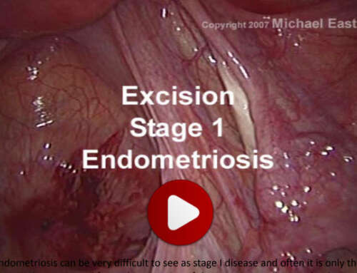 Excision of stage I and II endometriosis