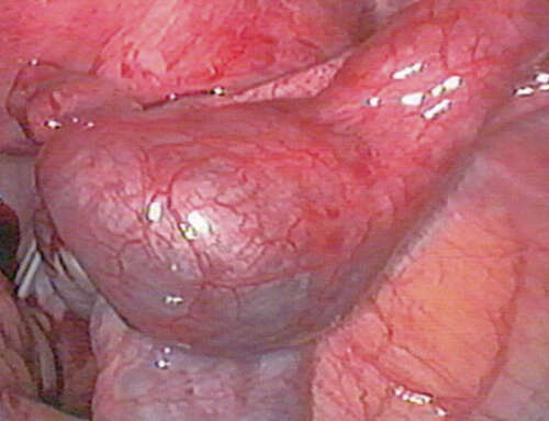 Ectopic pregnancy