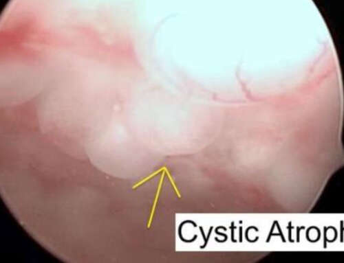 Senile Cystic Atrophy in Postmenopausal Women: Correlation between Hysteroscopic View with Histopathological Diagnosis and Serum Estradiol levels – Preliminary Analysis