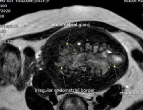 Extra-ordinary High Cancer antigen 125 (CA-125) level in a 41 year-old patient with adenomyosis