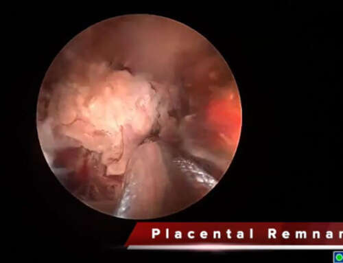 Cervical niche placental remnants removal by the Intrauterine Bigatti Shaver (IBS)