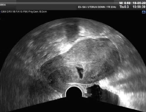 Cesarean Scar Pregnancy: Case reports
