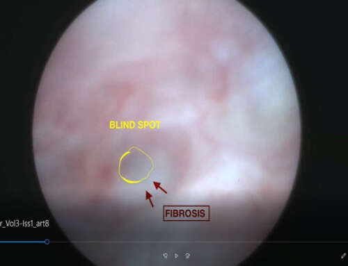 Cervical Stenosis: In – office Hysteroscopy Treatment using Hysteroscopic Tissue Removal System