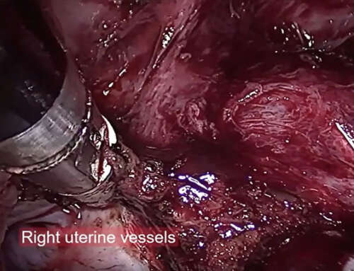 vNOTES hysterectomy technique in a case with big broad ligament fibroid: Video Article
