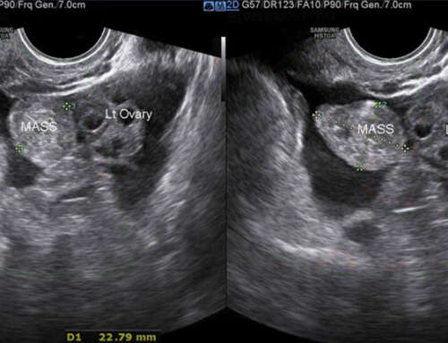 Transvaginal Natural Orifice Transluminal Endoscopic Surgery (vNOTES) salpingotomy for ectopic pregnancy: Video Article