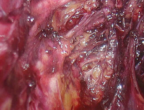 Laparoscopic nerve sparing radical hysterectomy without uterine manipulator in persistent cervical cancer after chemoradiation: Video Article