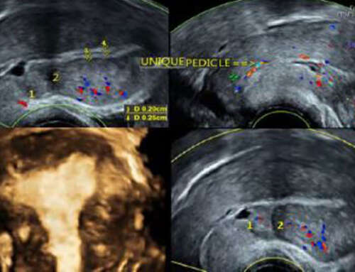 A new hysteroscopic aspect for adenomyosis: case report