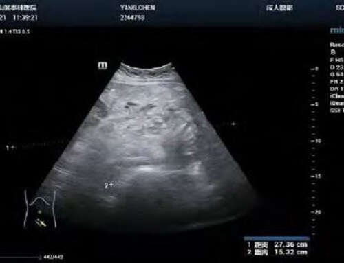 A case of giant uterine fibroid with pregnancy