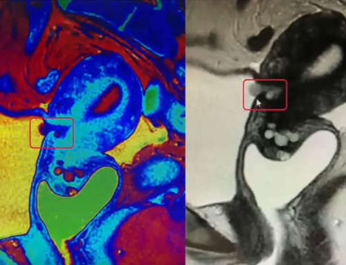 A rare case of a vesicouterine fistula managed by 3 minimally invasive approaches (Video Article)