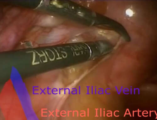 Pelvic Anatomy: Unusual Anatomical Ureteric Variation Do we need to be aware of ? Video Case report
