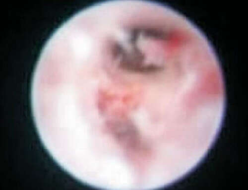 Diagnostic hysteroscopy: complications, Diagnosis and management