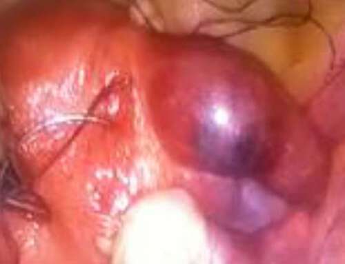 Laparoscopic approach in the management of interstitial ectopic pregnancies: A report of four challenging cases in Yaounde Gynaeco-Obstetric and Pediatric Hospital, CAMEROON