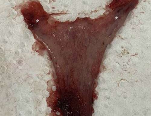 A Rare Case of En Bloc Endometrium Shedding