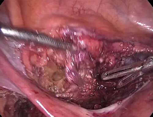 Novel Use of a Laparoscopic Round Ligament Flap with uretero-neocystostomy in Urinary Tract Endometriosis (Video)