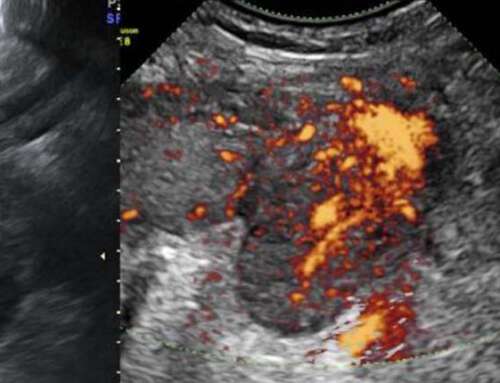 Left ovarian vein thrombophlebitis in the postpartum period